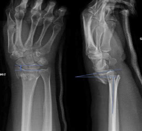 Preoperative X-rays and radiographic measurements. Intra-articular... | Download Scientific Diagram