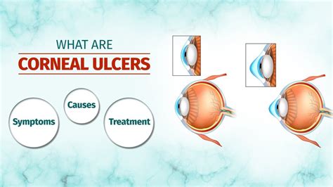 What are Corneal Ulcers? Symptoms, Causes, Treatment Options and More - YouTube