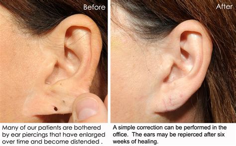 Earlobe Repair, Mole Removal, & Additional Services Before & After ...