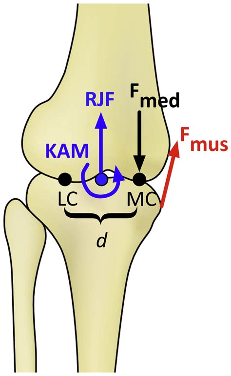 Medial knee joint contact force in the intact limb during walking in recently ambulatory service ...