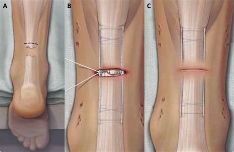 Achilles Tendon Rupture | Tendon Pain | The London Foot & Ankle Clinic