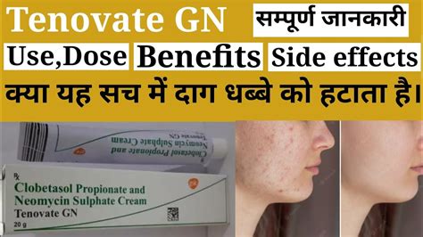 Tenovate GN cream use dose benefit and side effects full review in hindi.Tenovate GN cream in ...