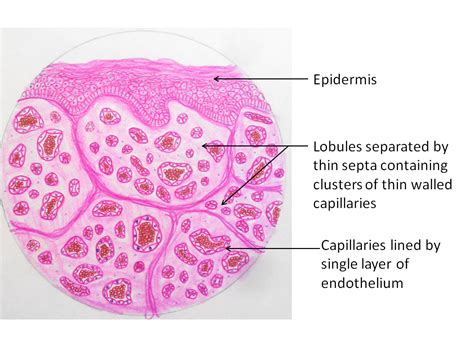 Capillary Hemangioma - Pathology Made Simple