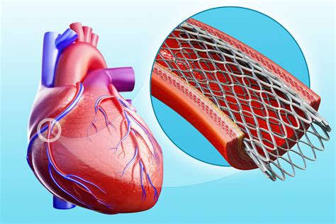 Heart Cath No Stent at Robert Beck blog