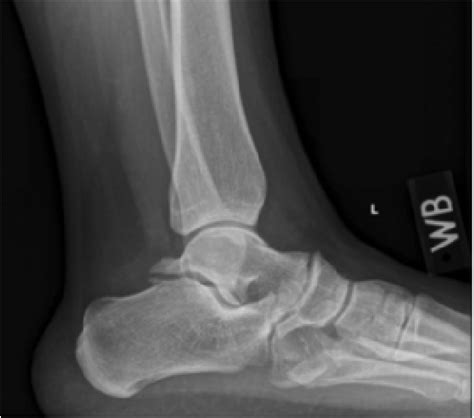 When Patients Present With Posterior Ankle Impingement