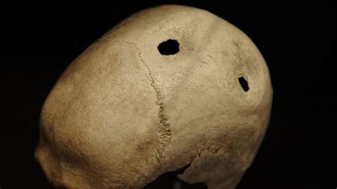 You Need It Like a Hole in the Head: The Ancient Medical Art of Trepanation | HowStuffWorks