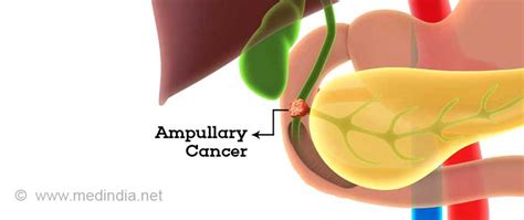 Ampullary Cancer Causes Symptoms Diagnosis Treatment