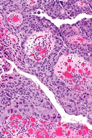 High-grade papillary urothelial carcinoma - Libre Pathology