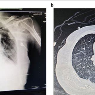 Chest imaging examinations. a Chest X-ray on the day after surgery ...