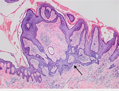 Tumor of follicular infundibulum demonstrating interanastomosing ...