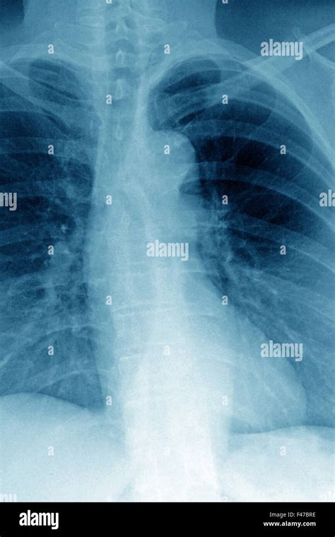 ATHEROMATOUS AORTA, X-RAY Stock Photo - Alamy