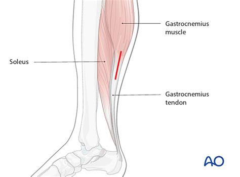 Release of the gastrocnemius equinus