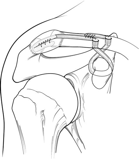 Figure 7 from The anatomic coracoclavicular ligament reconstruction ...