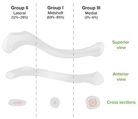 Clavicle Fracture Classification