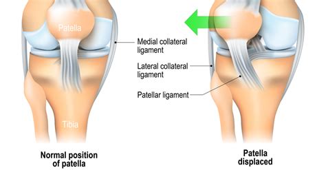 Patellar Dislocation: Signs, Symptoms, Treatments | Total Orthopedics ...