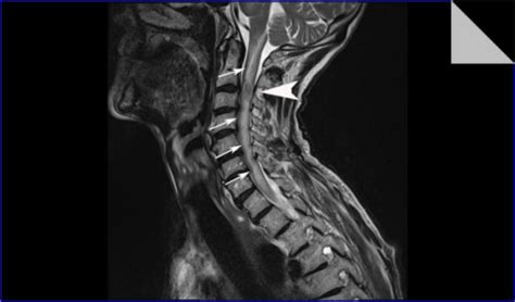 Sagittal T2-weighted MRI of his cervical spine shows an | Open-i