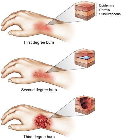 Treating Second Degree Burn On Foot Deals | emergencydentistry.com