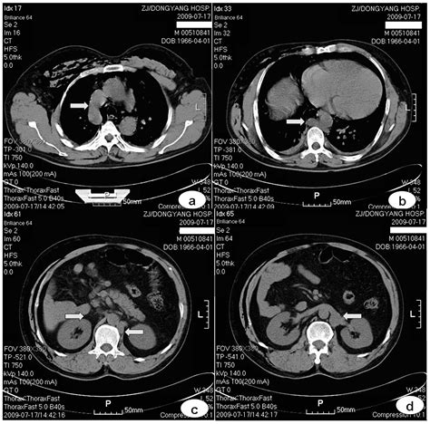 Computed tomography manifestations of common inferior vena cava ...