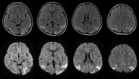 Dr Balaji Anvekar FRCR: Viral Encephalitis MRI