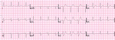 Dr. Smith's ECG Blog: Is the LAD really completely occluded when there ...