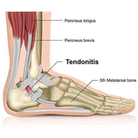 Peroneal Tendonitis: Causes, Symptoms & Treatment · Dunbar Medical