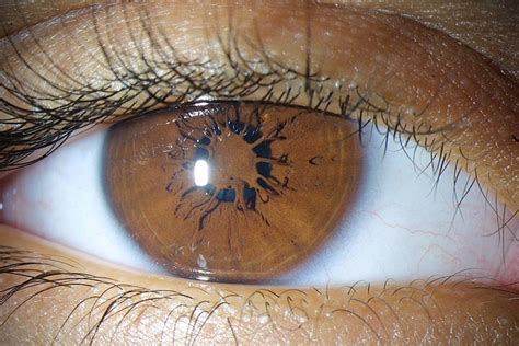 Persistent pupillary membrane (PPM) is a condition of the eye involving remnants of a fetal ...