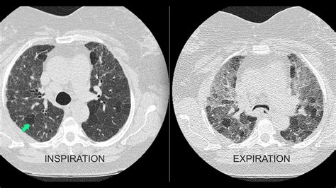 Air trapping on the chest x-ray and CT scan - YouTube