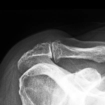 Moderate Acromioclavicular Osteoarthritis