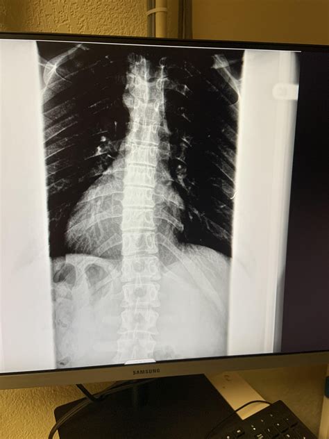 My slightly crooked spine : r/XRayPorn