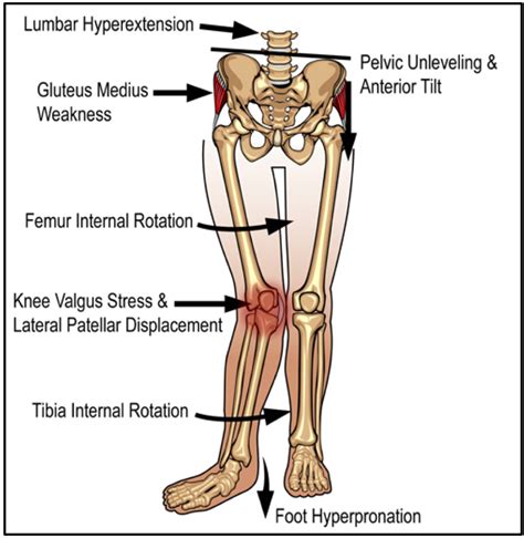 Patellofemoral Pain Syndrome (PFPS) — PhysioFlow