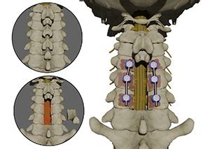 Posterior Cervical Decompression Oklahoma City, OK | Herniated Discs Fort Smith, AR