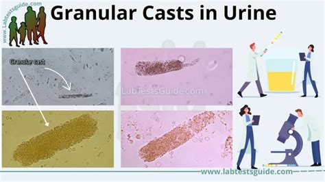 Granular Casts: Definition, Types, Causes, and Clinical Significance