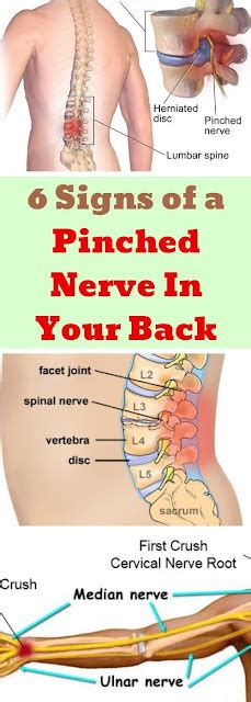 Here Are 6 Signs Of A Pinched Nerve In Your Back!!! - Famous Comedy Humor