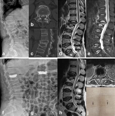 A 69-year-old woman suffered L1 vsOVCF with spinal canal compromise... | Download Scientific Diagram