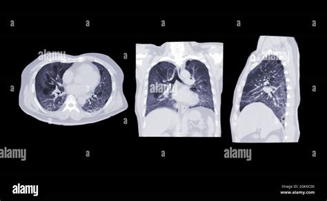 Collection of CT scan of Chest or lung axial, coronal and sagittal view ...