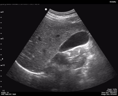 Ultrasound (US) – Undergraduate Diagnostic Imaging Fundamentals