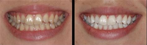 Advice On The Best Teeth Whitening Products