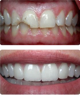 Porcelain Veneers Procedure Toronto | Family Tree Dental | Family Tree Dental