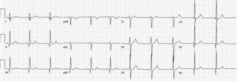 Hypertrophic Cardiomyopathy (HCM) • LITFL • ECG Library Diagnosis