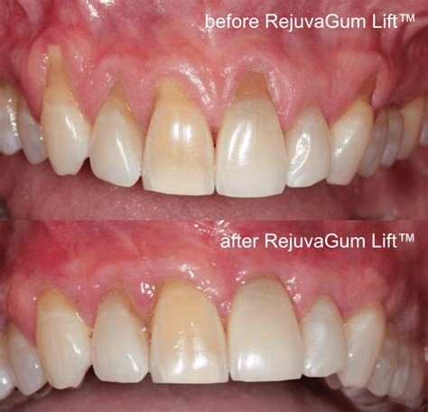 Gum Grafting Alternative Surgery by Beverly Hills Experts