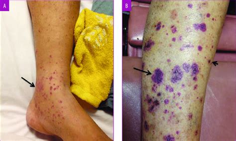 A: Initial presentation of recurrent painful petechiae and palpable... | Download Scientific Diagram