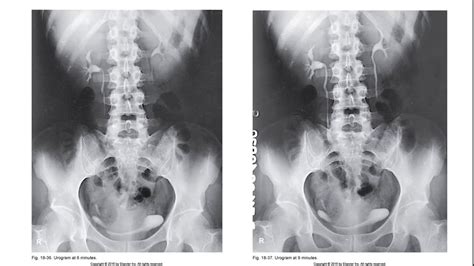 Intravenous Urography - YouTube