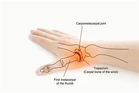 Thumb MCP Joint Pain Symptoms and Treatment by CopperJoint