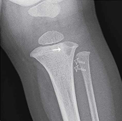 Who’s Brodie? Brodie abscess | Radiology Key