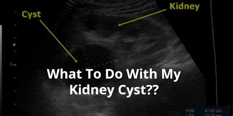 Wellness Lab Health Info: What To Do With My Kidney Cyst??