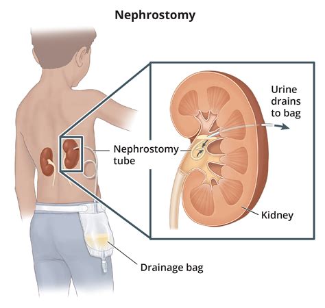 Nephrostomy Stoma