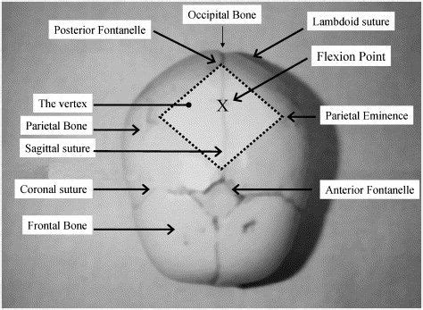 The bones, sutures and fontanelles of the fetal skull, illustrating the vertex (shaded area) and ...