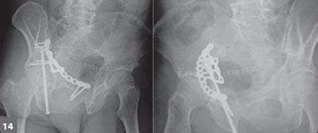 Modified Stoppa approach is effective for fixing acetabular fractures from the front