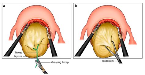 JCM | Free Full-Text | New Surgical Technique for Robotic Myomectomy ...