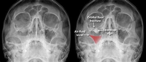 Blowout Fracture